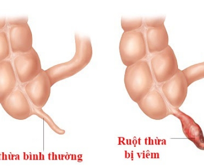 Người bệnh cần làm gì nếu nghi ngờ viêm ruột thừa?
